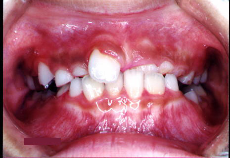 前歯の歯ならびが悪い