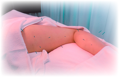 腰痛・坐骨神経痛の電気鍼と鍼灸治療