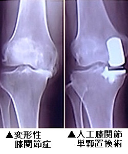 変形性膝関節症レントゲン画像