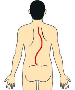 脊柱側弯症解説背面図