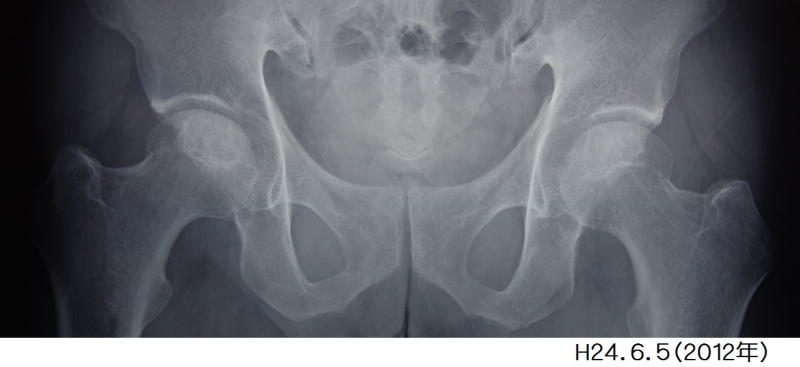 性 壊死 特発 症 骨頭 大腿 大腿骨頭壊死とは。手術によって治るのか？
