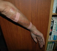 腕の傷